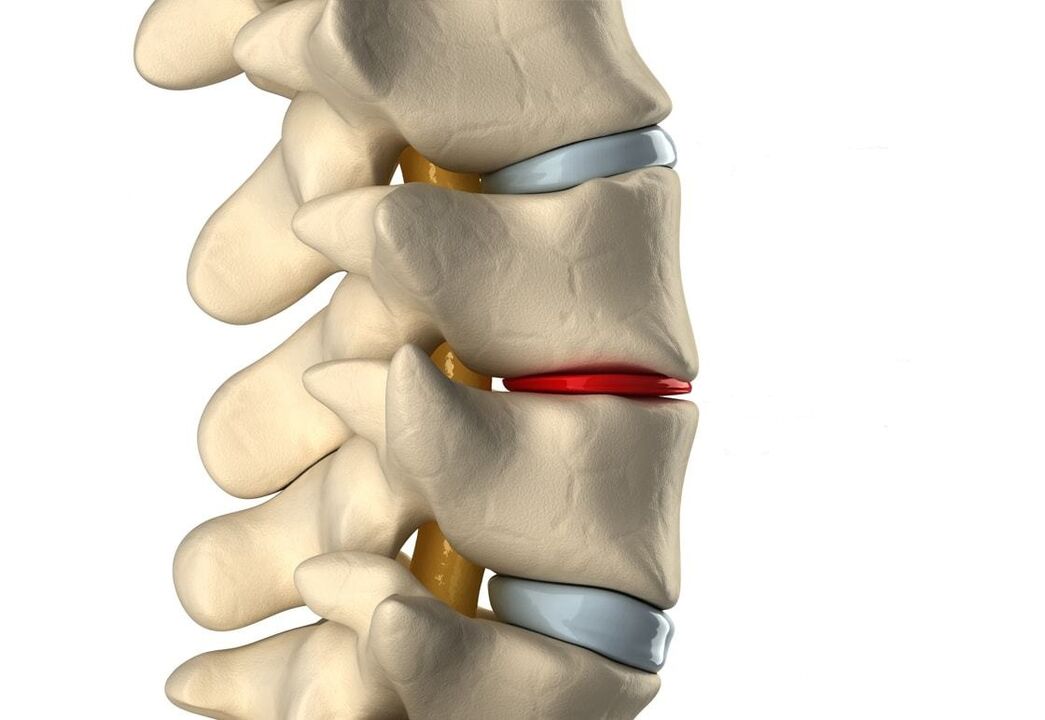 Healthy intervertebral discs (blue) and damaged due to thoracic osteochondrosis (red)