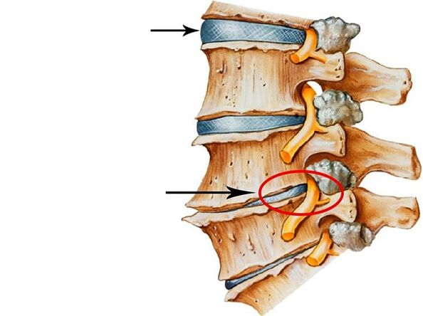 Disorders of the intervertebral disc