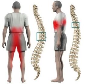 Bulge in the spine