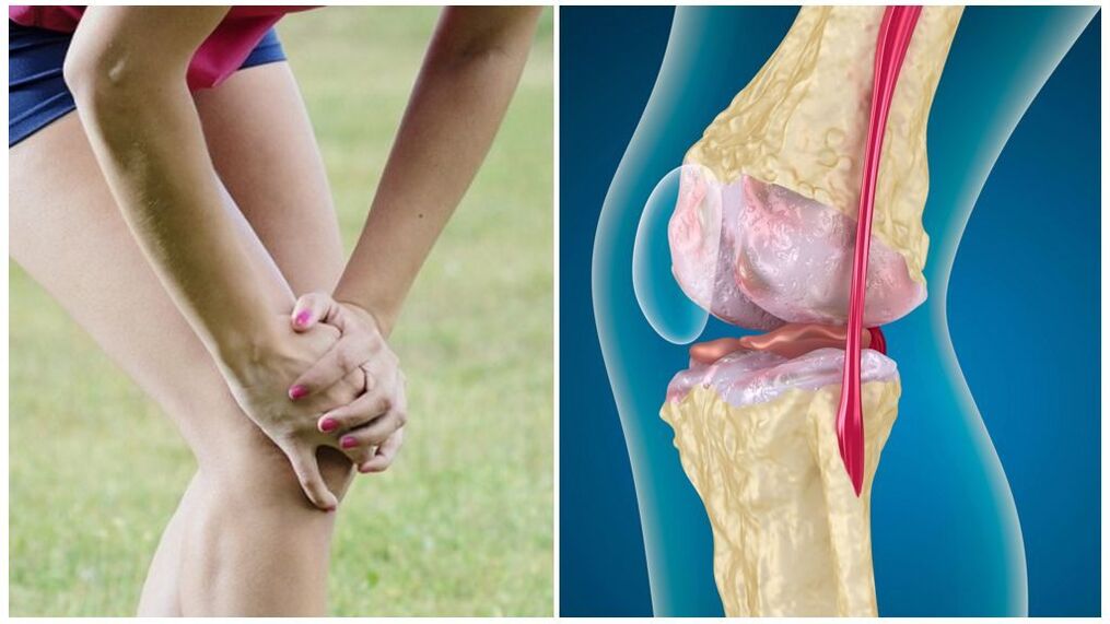 arthritis symptoms