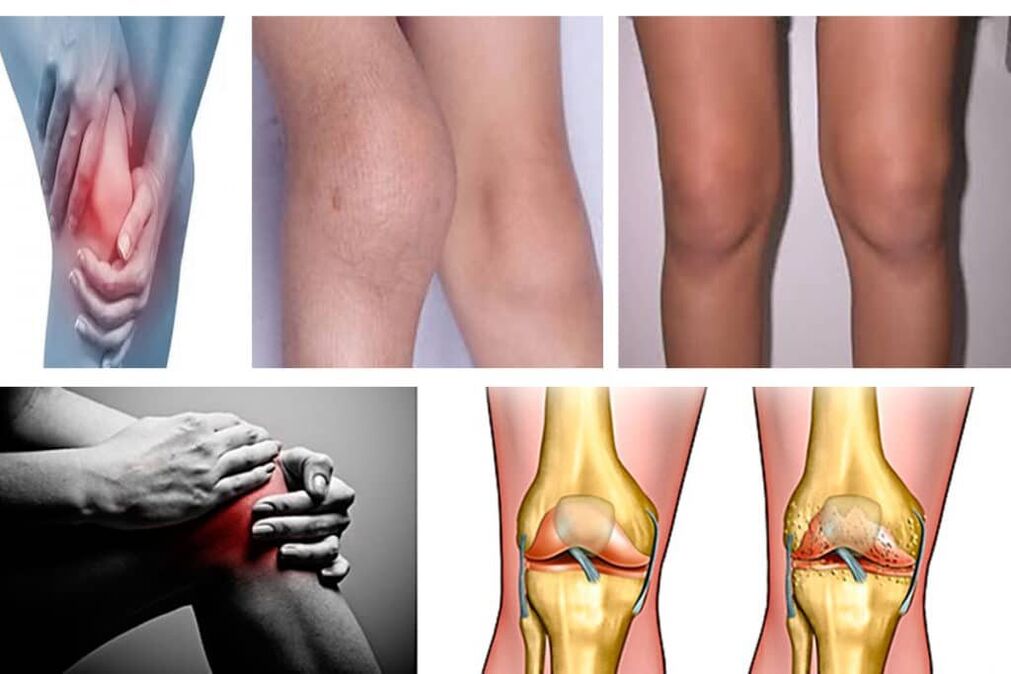 arthritis what is it