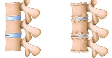 how to recognize the existence of lumbar osteochondrosis